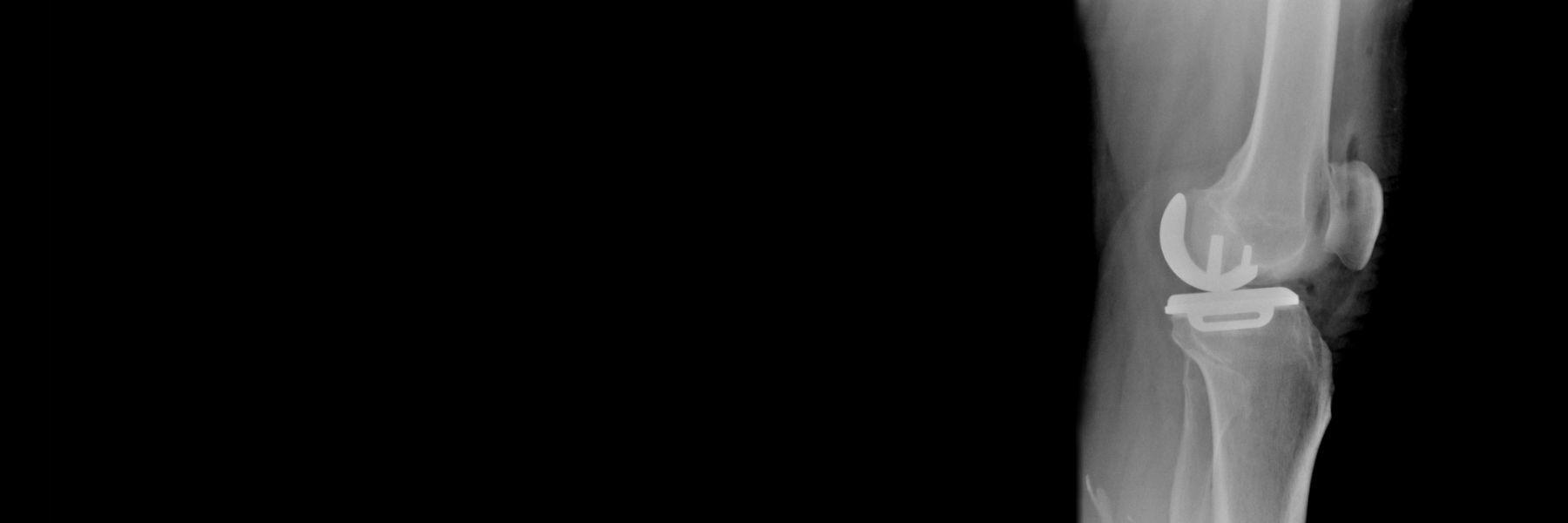 Partial (Unicompartmental) Knee Replacement | Orthopedic Surgeon