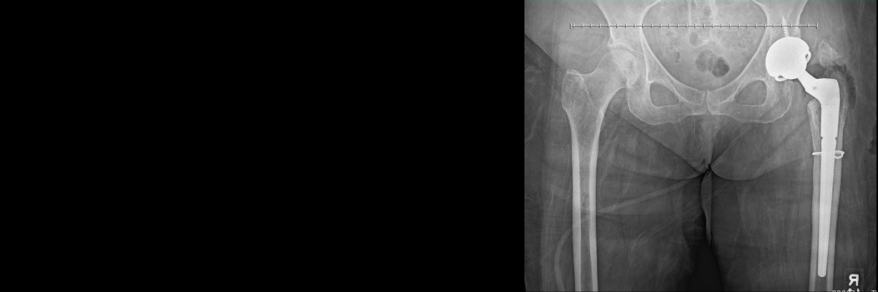 Revision Hip and Knee Replacement | Orthopedic Surgeon