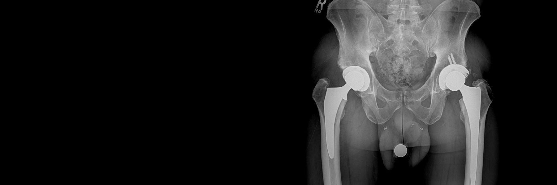 Total Hip Replacement | Orthopedic Surgeon